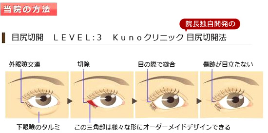 ダウン 目尻 タイム 切開