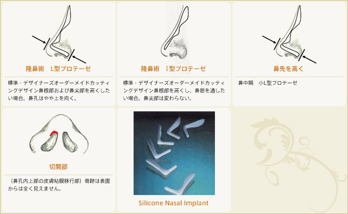 隆鼻プロテーゼ 種類と効果図説