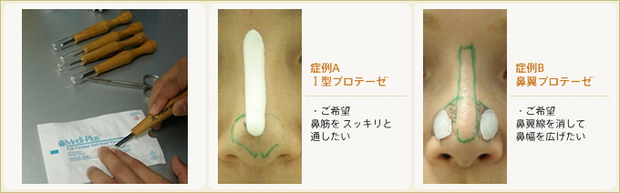 隆鼻プロテーゼ カッティングデザイン図説