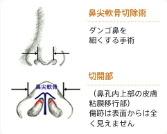 鼻尖軟骨切除術