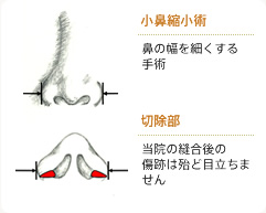 小鼻縮小術