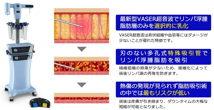 リンパ浮腫吸引根治術