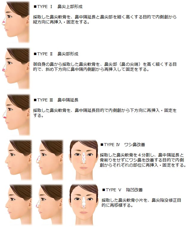 鼻尖軟骨切除 ＆ 再移植 Ⅰ~Ⅴ